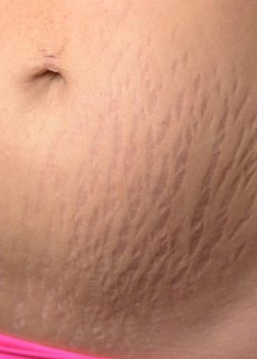 Microneedling For Body Starts From