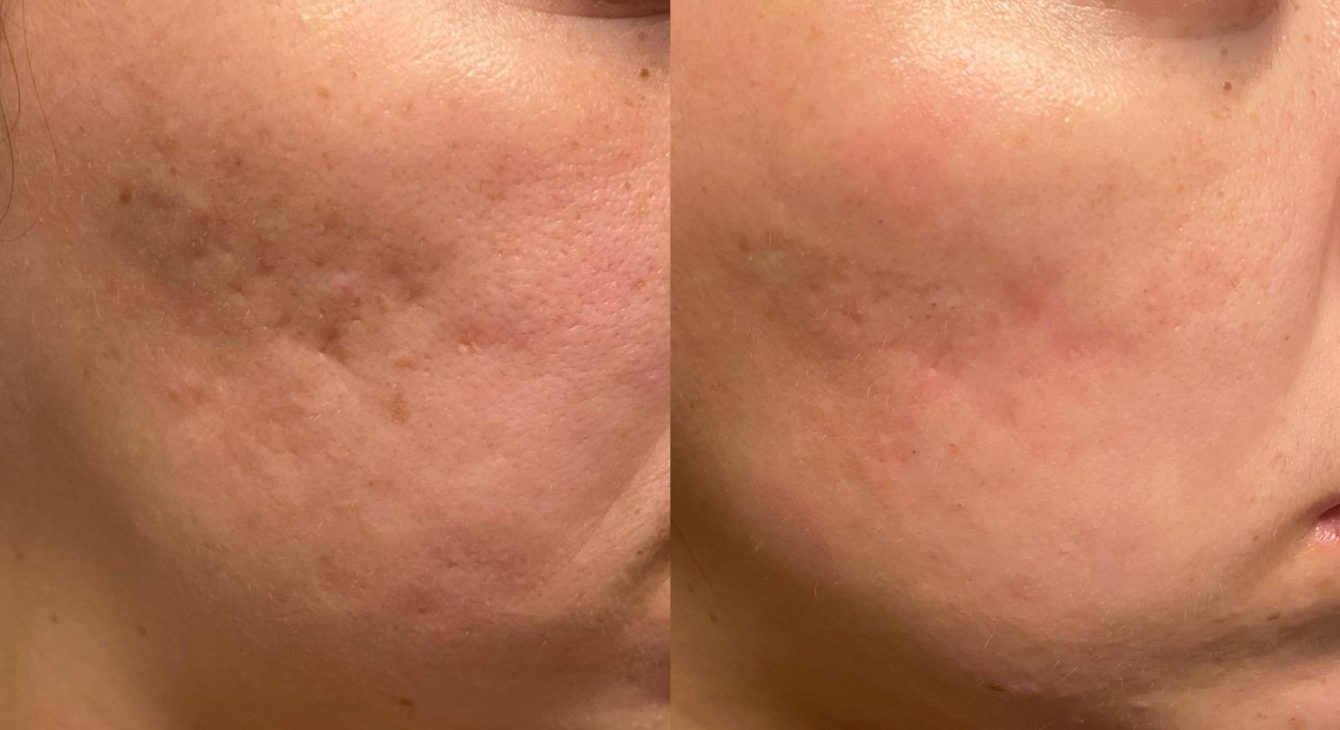 Microneedling Single Session2