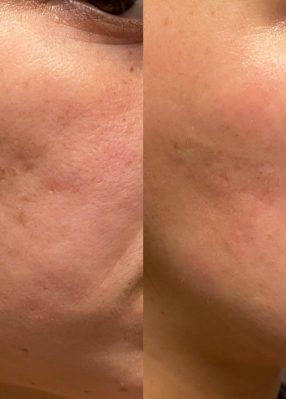 Microneedling Single Session2