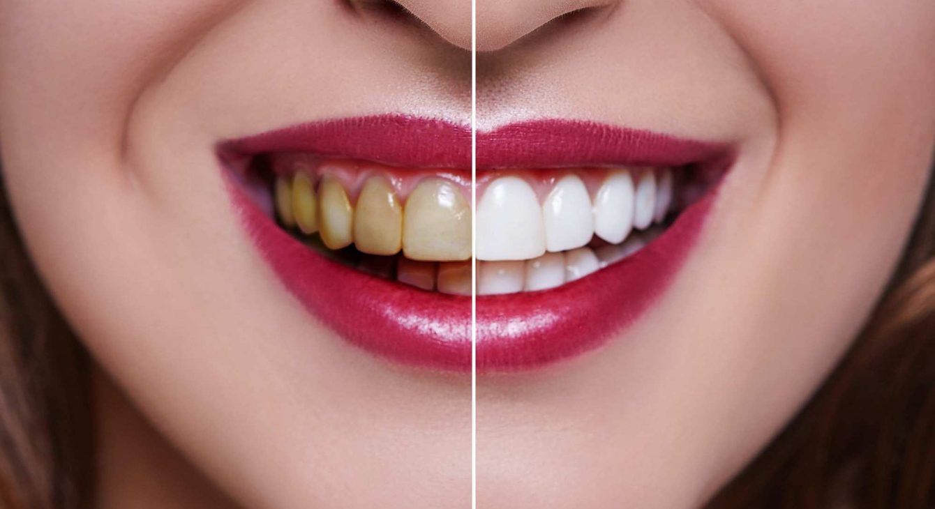 Teeth Whitening Initial Appointment