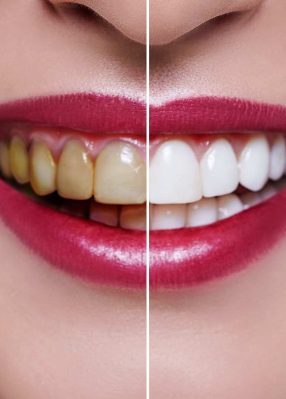 Teeth Whitening Initial Appointment